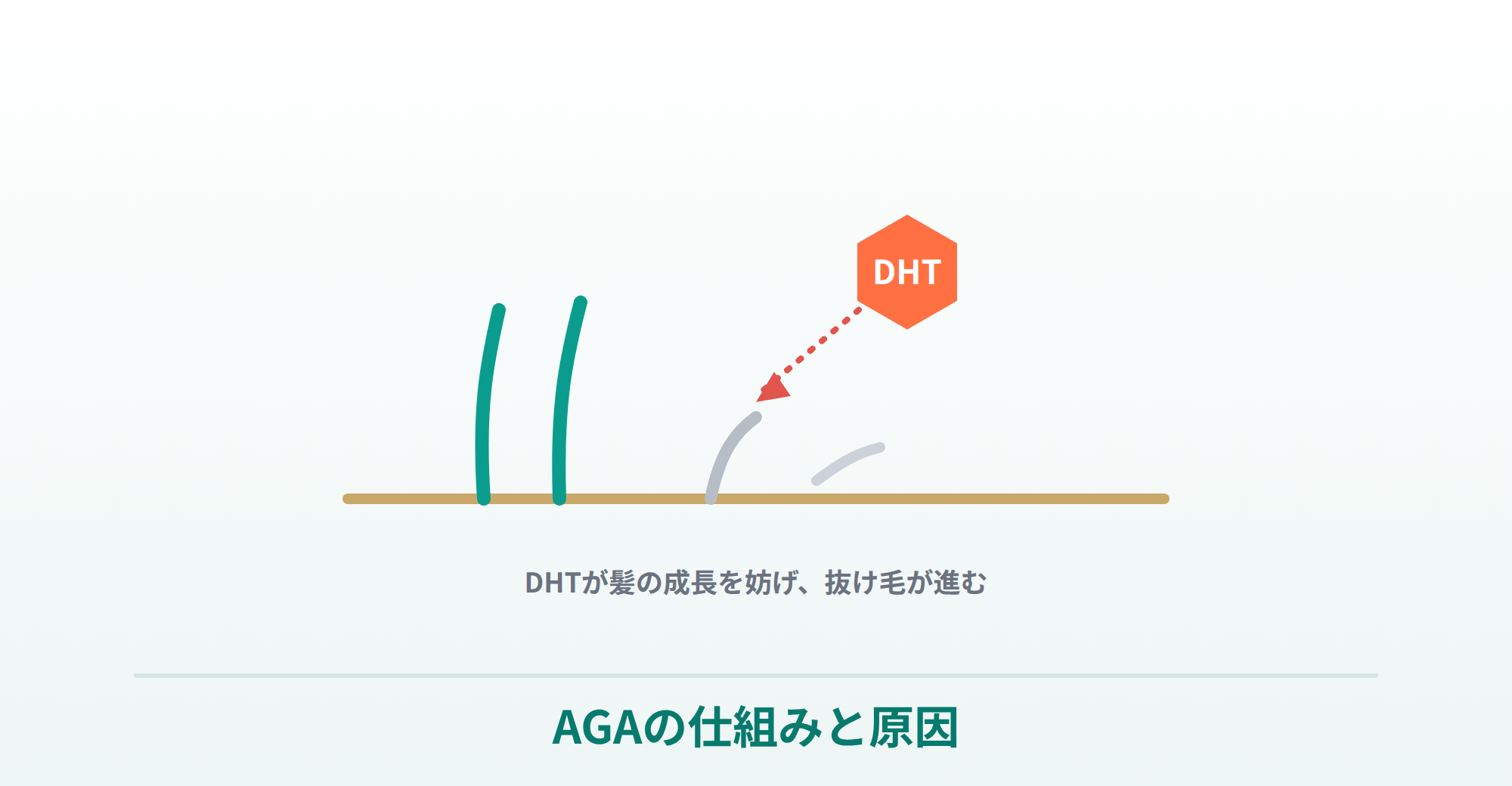薄毛治療（AGA）の仕組みと原因（DHTが抜け毛の原因）を表した画像