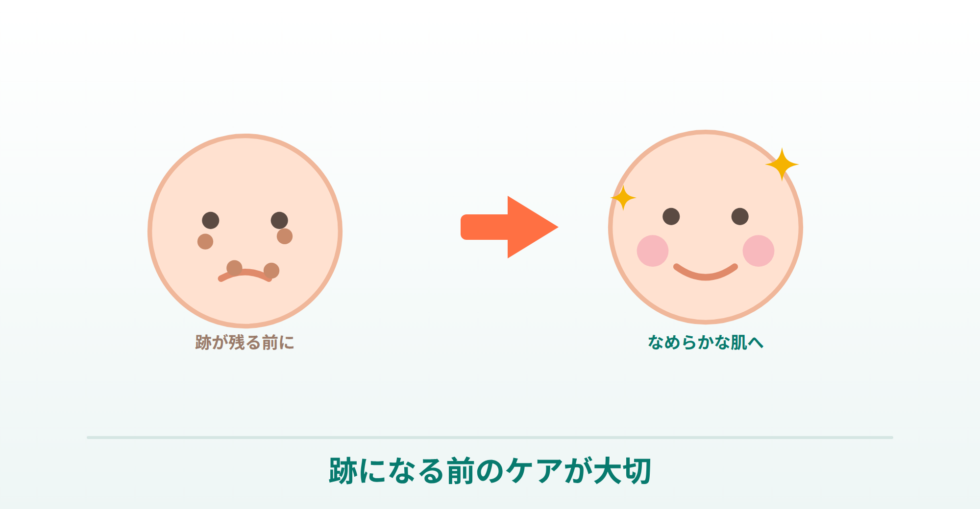ニキビ跡のケアと予防を説明する画像